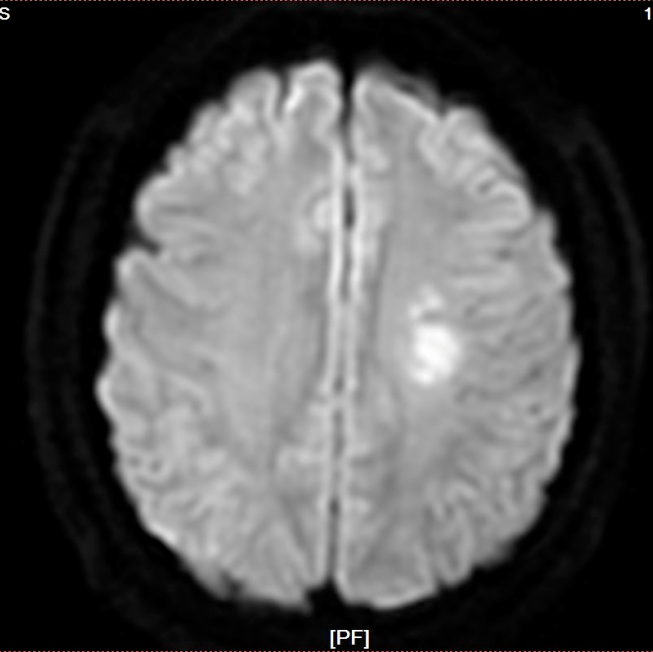 mri:左侧半卵圆中心,脑室旁,额叶深部急性梗死灶.(2020-09-19)