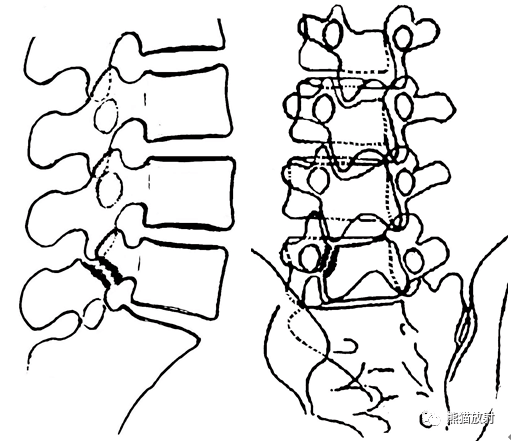 椎弓崩解示意图:侧/斜位片