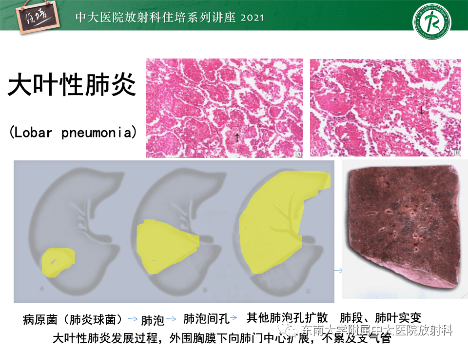 中大放射住培系列讲座常见细菌性肺炎与病毒性肺炎的鉴别诊断