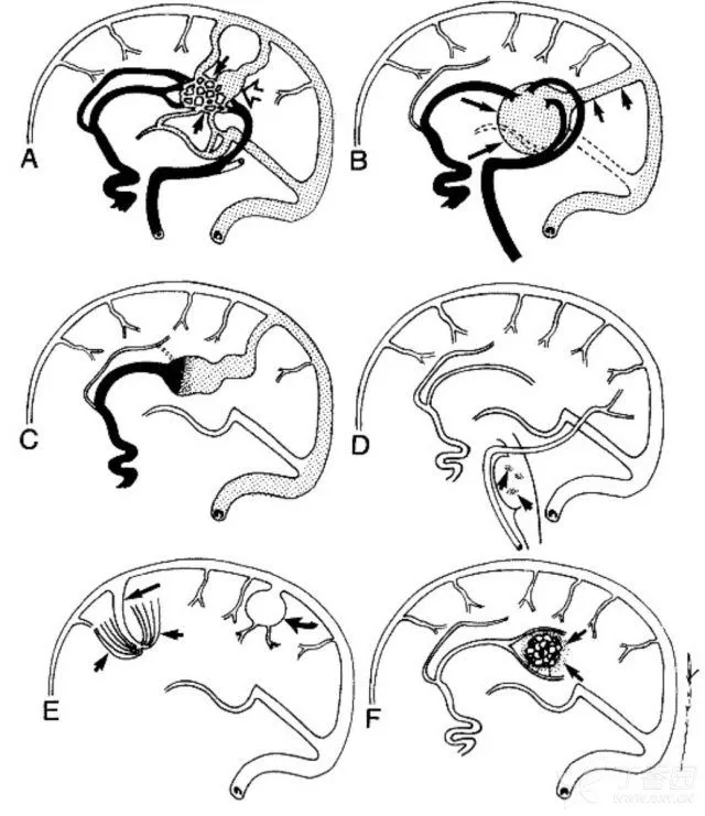 各种血管畸形的示意图