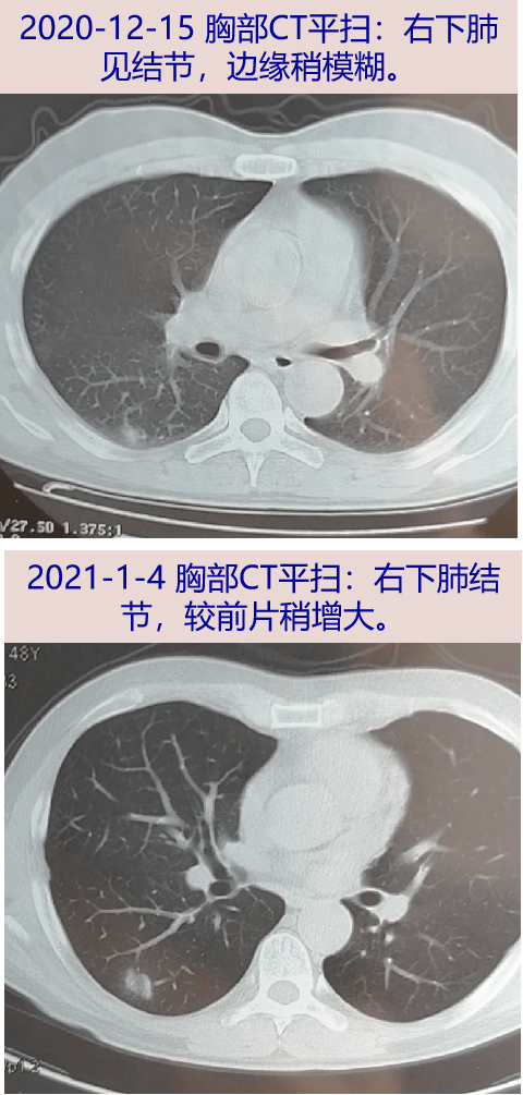 探案丨咳嗽咳痰肺结节别的不怕就怕得癌