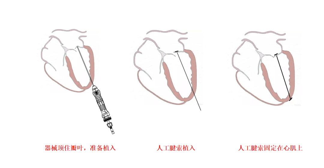 亚洲首例穿刺式二尖瓣腱索重建手术!