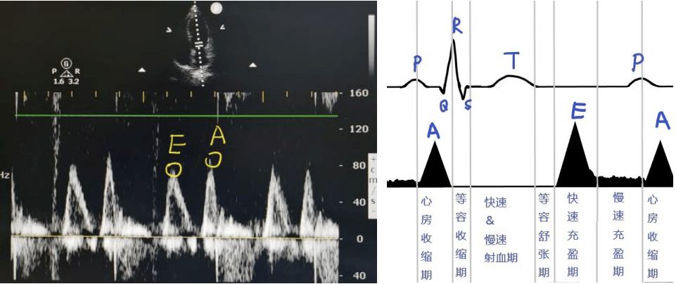 心脏超声报告不会看?先熟记这 6 大指标!