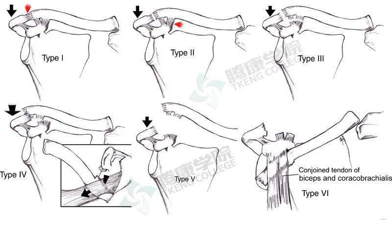 Ⅴ型:肩锁韧带和喙锁韧带撕裂,伴有三角肌斜方肌筋膜撕裂,锁骨从肩峰
