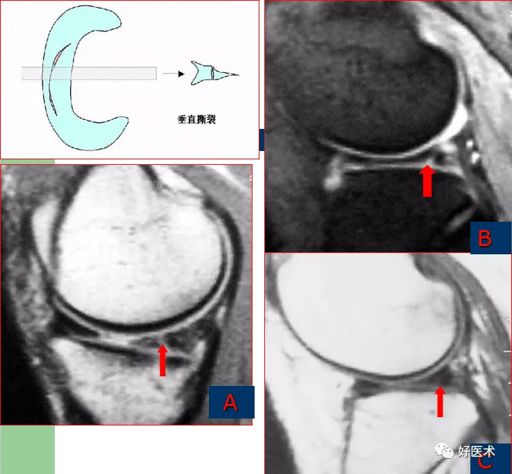 pd像见板内高信号线贯穿半月板上下关节缘.