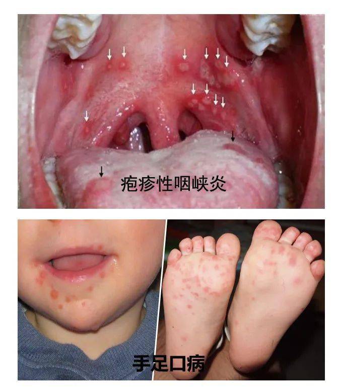 轻症的手足口病主要表现是手,脚,嘴巴里长红色丘疹或水疱,伴有发烧