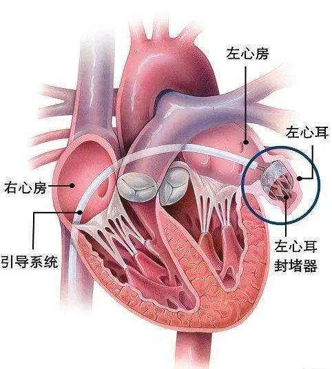 宝鸡第三医院成功开展首例房颤射频消融左心耳封堵一站式手术