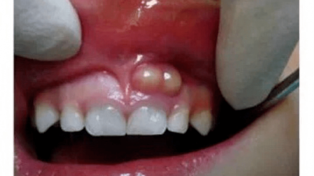 口腔科普牙龈反复长脓包它可能是在提示你