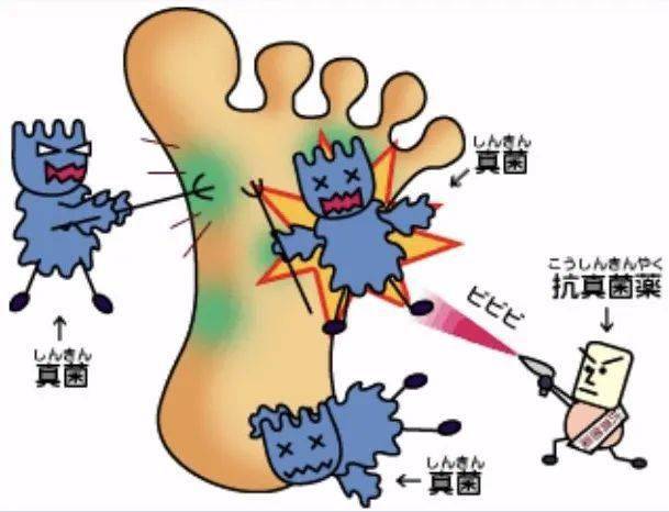 科普真菌感染性皮肤病的防治