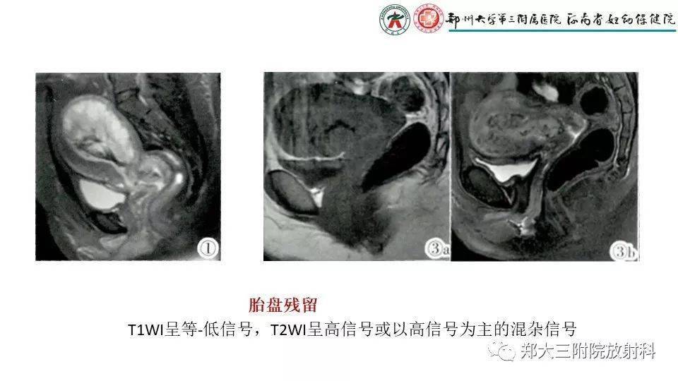 产后胎盘残留的mri影像表现