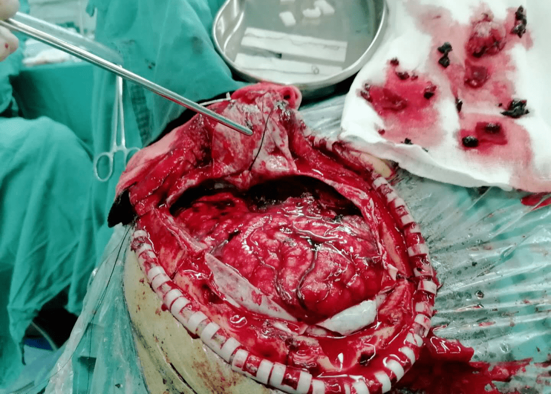 术前影像 患者手术时予以清除硬膜下血肿及右侧颞叶脑挫裂伤后,再