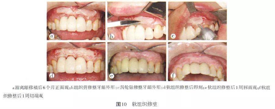 龈瓣经简单修剪处理后,移植于受瓣区,5-0可吸收线将游离龈片缝合固