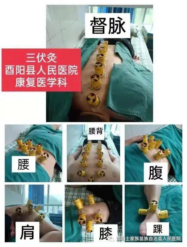 县人民医院2021年春夏养阳,冬病夏治之三伏灸开始了