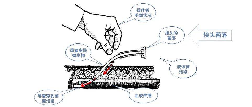 但随之产生的并发症问题也日益突出,其中以导管感染相关性感染(cri)为