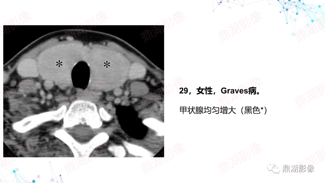 炎影像表现会厌炎影像表现右侧恶性外耳道炎影像表现阅片的基础是解剖