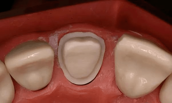 全瓷冠备牙时容易被牙医忽视的四个问题
