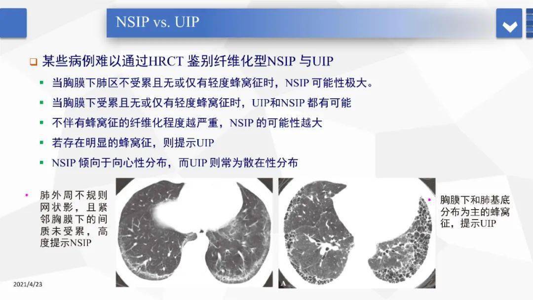 间质性肺炎的hrct诊断与鉴别诊断