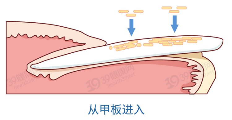 真菌感染导致灰指甲是"甲癣"的俗称灰指甲到底是个啥跟你们聊一聊这个