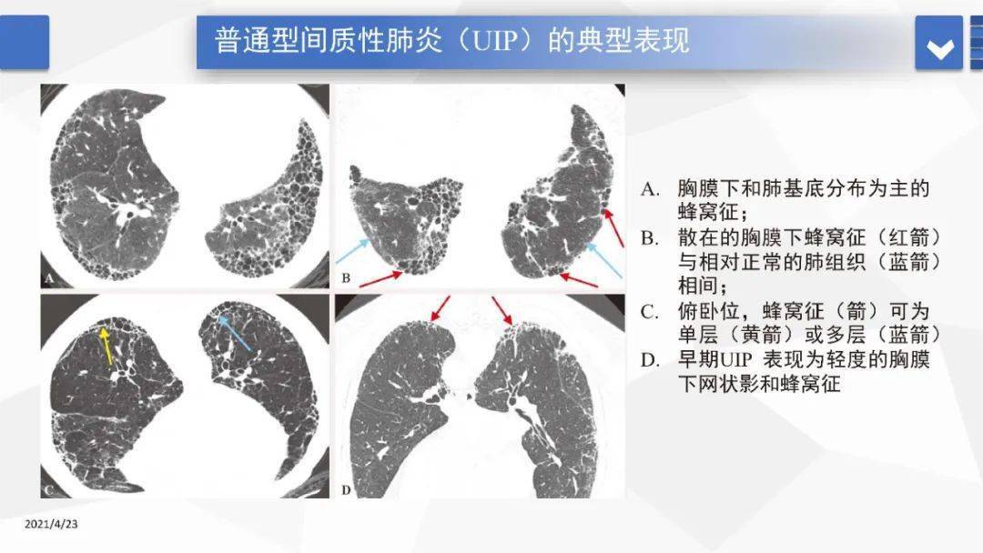 间质性肺炎的hrct诊断与鉴别诊断