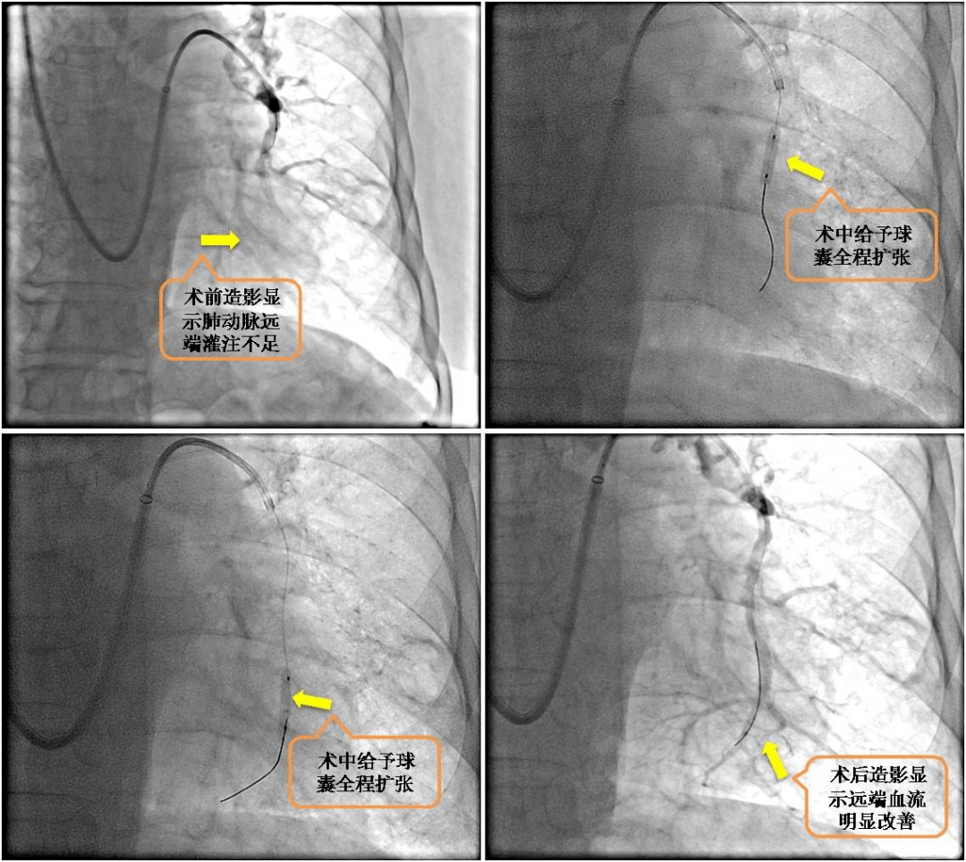 我院成功实施首例肺动脉球囊扩张成形术_高压