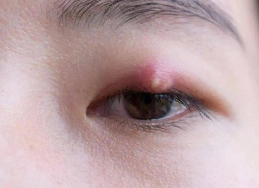 长在眼皮上 像痘痘一样的东西咱们俗称"针眼" 医学上它叫做【麦粒肿】