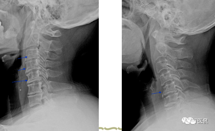 颈椎病解剖经典影像