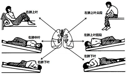 肺腑之言痰粘咳不出来反复肺部感染试试气道廓清技术吧