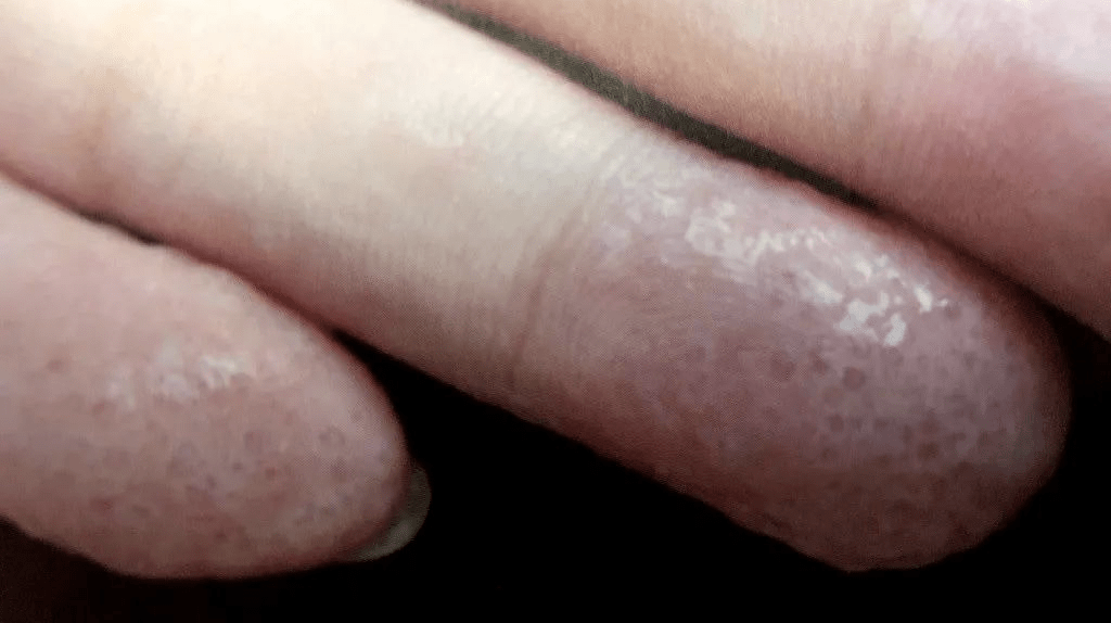 汗疱疹也称汗疱湿疹,是复发性水疱性皮肤病.