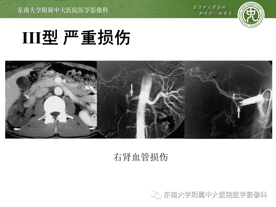 肾脏外伤影像学评估