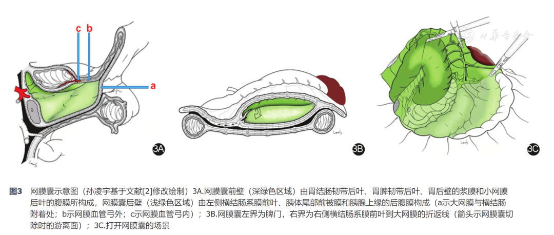 期胃癌需从大网膜与横结肠附着处切开(图3a箭头a所示)切除全部大网膜