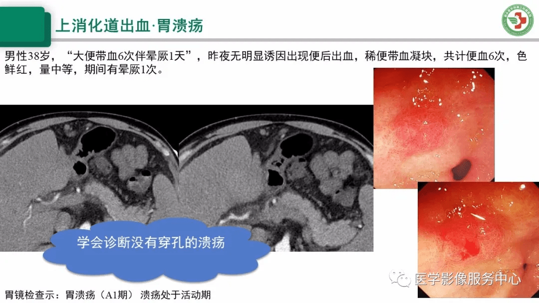 上消化道出血的ct诊断