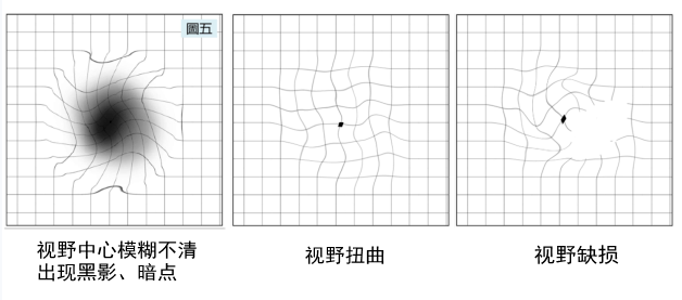 黄斑病变患者的视野3,头痛,虹视,视野缺损,青光眼正在夺走你的视力