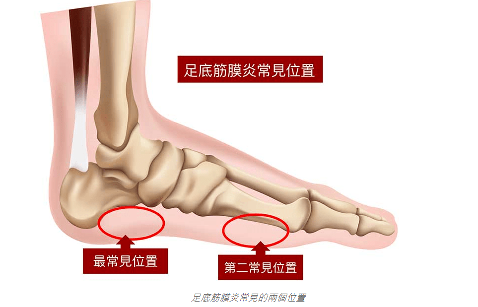 脚跟脚底痛(足底筋膜炎)的4种经络组合型态,8种方法彻底解决!