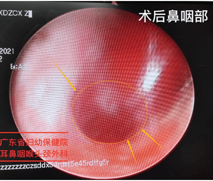 先天鼻腔狭窄至反复鼻塞张口呼吸7岁女孩手术通鼻