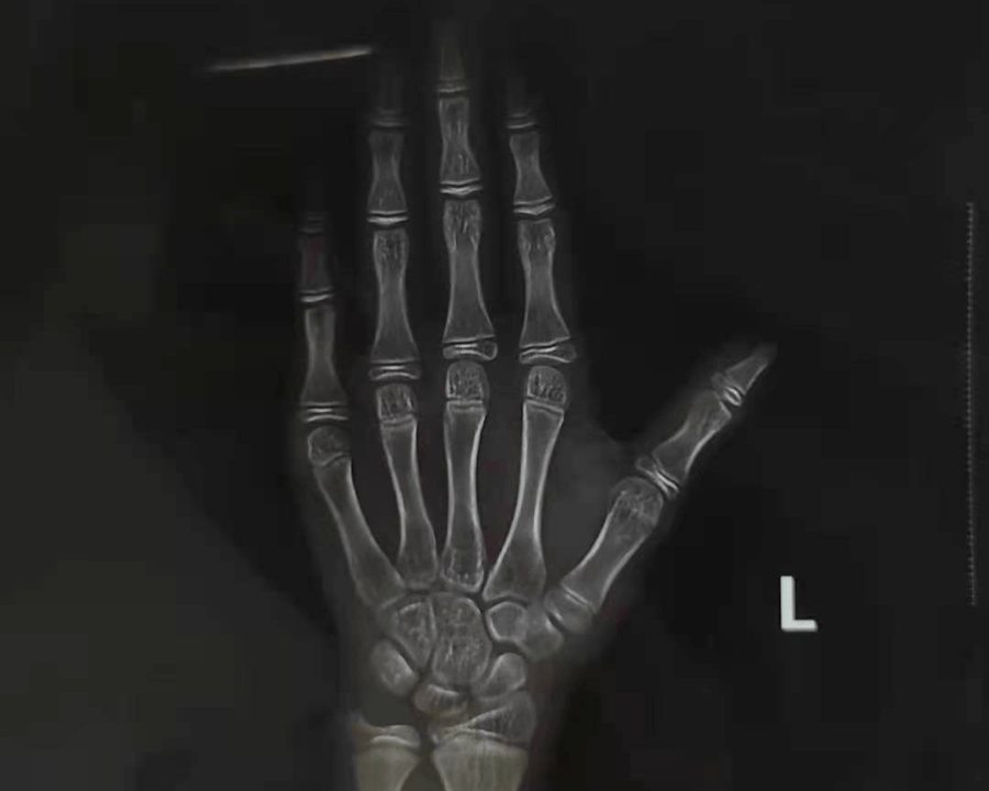 通常要拍摄左手手腕部位的x光片,通过x光片观察左手掌指骨,腕骨及桡