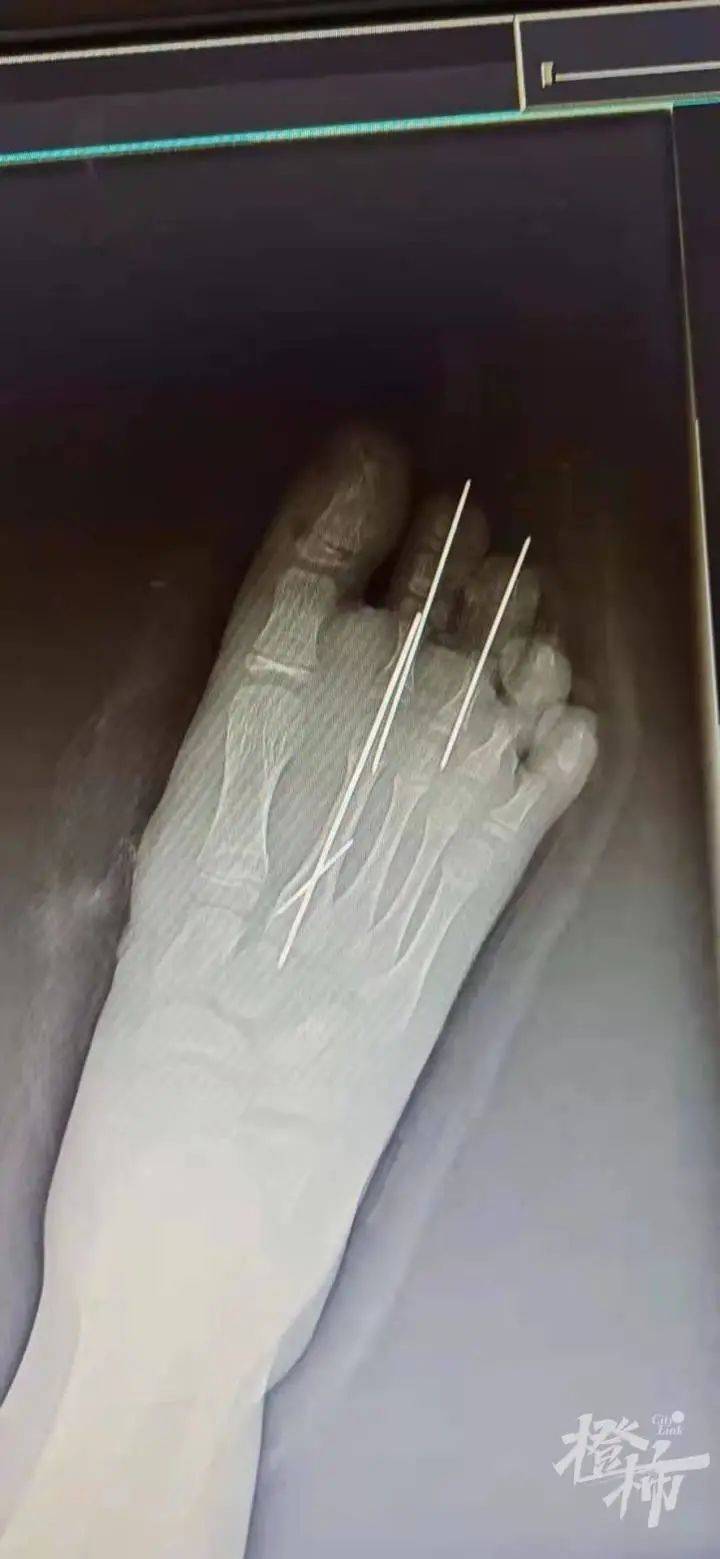 "右脚第一第二足趾离断,右足背大片皮肤软组织缺损,多发趾骨跖骨骨折.