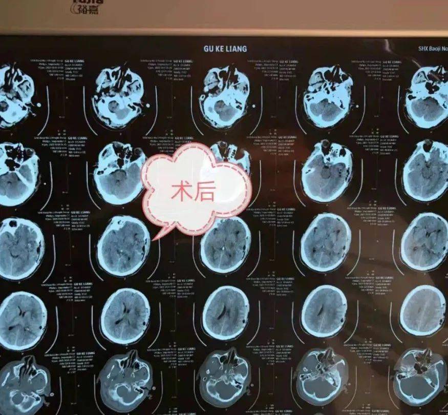 大小便失禁,家人呼120送入我院,急诊查头颅ct提示:左侧基底节区脑出血