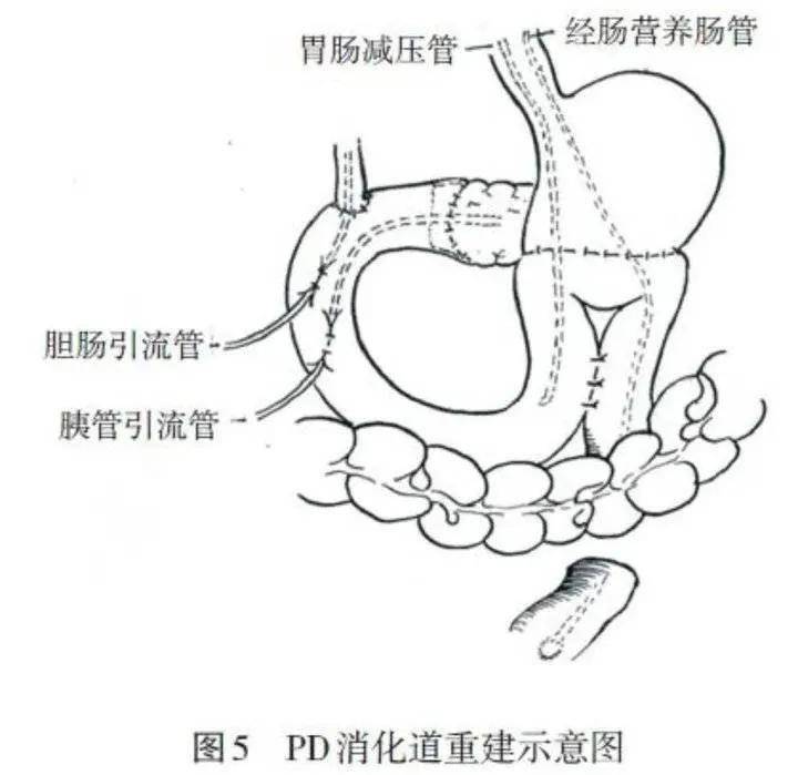 总管中下段肿瘤,十二指肠肿瘤,胰头癌等最有效的方法,但因该手术解剖