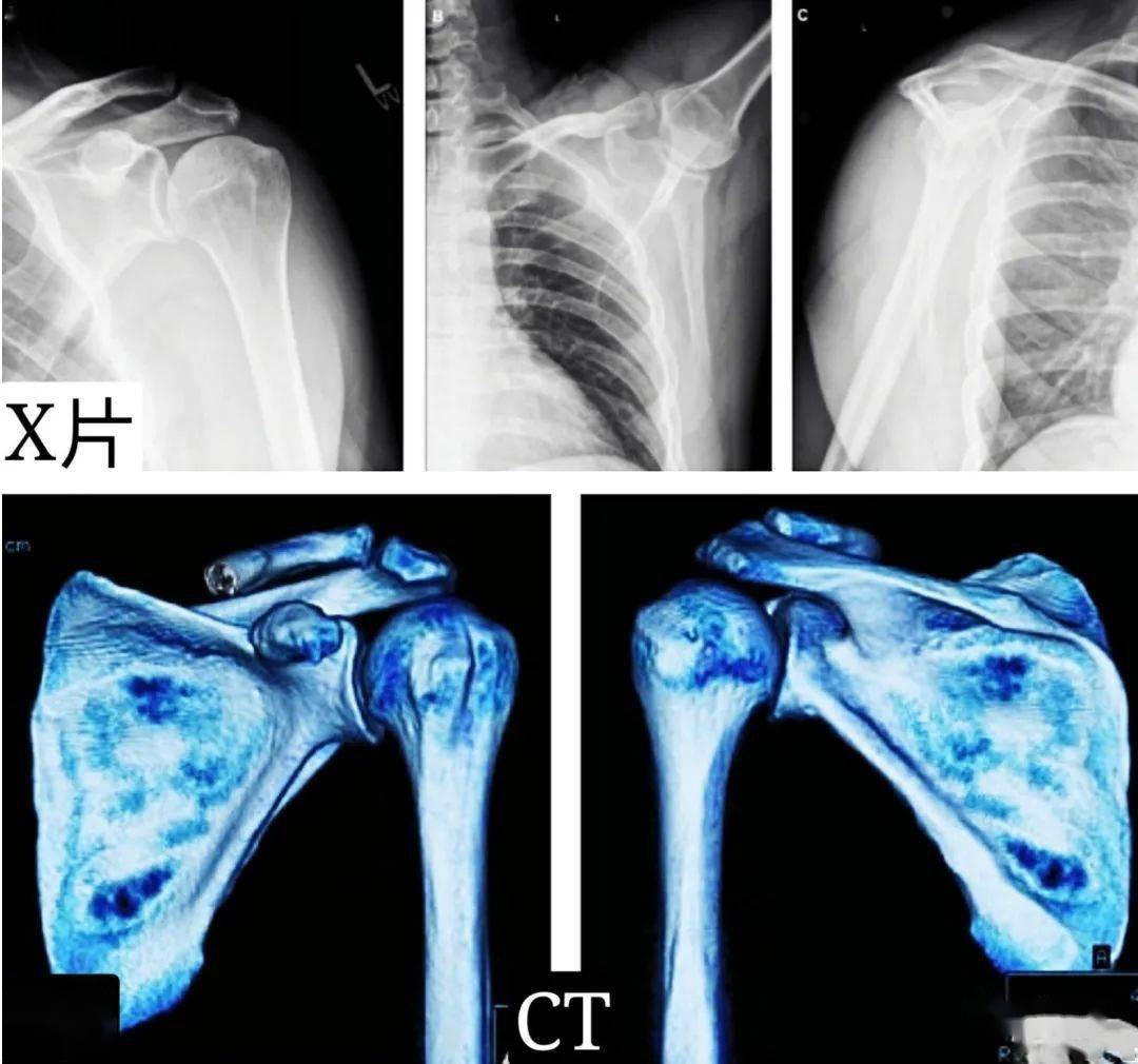需要注意的是:常规平片难以清晰观测肩胛骨腹侧,对于平片正常患者,但