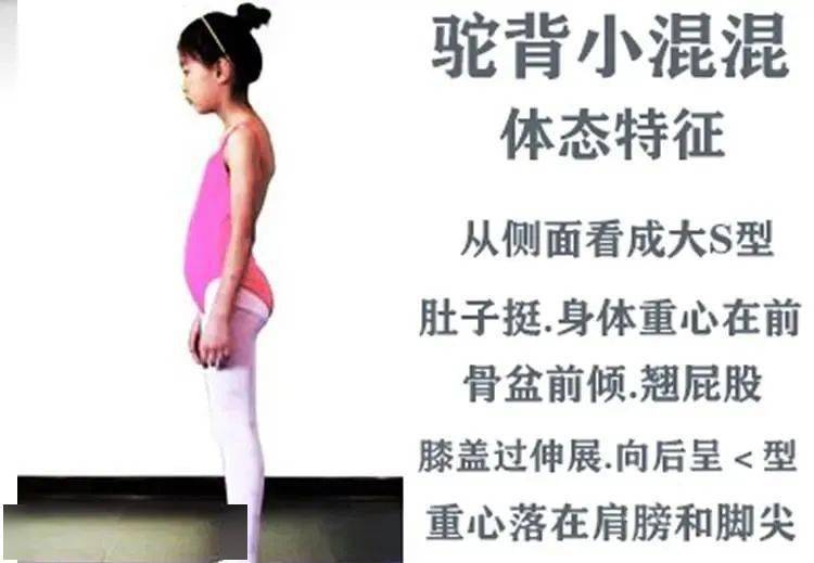 【少儿体态】两种常见驼背,你家孩子是哪一种?