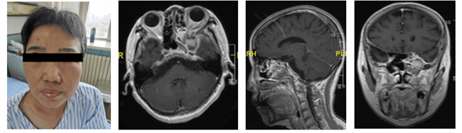 手术|哈医大一院完成内镜下复杂颅内外沟通病变手术