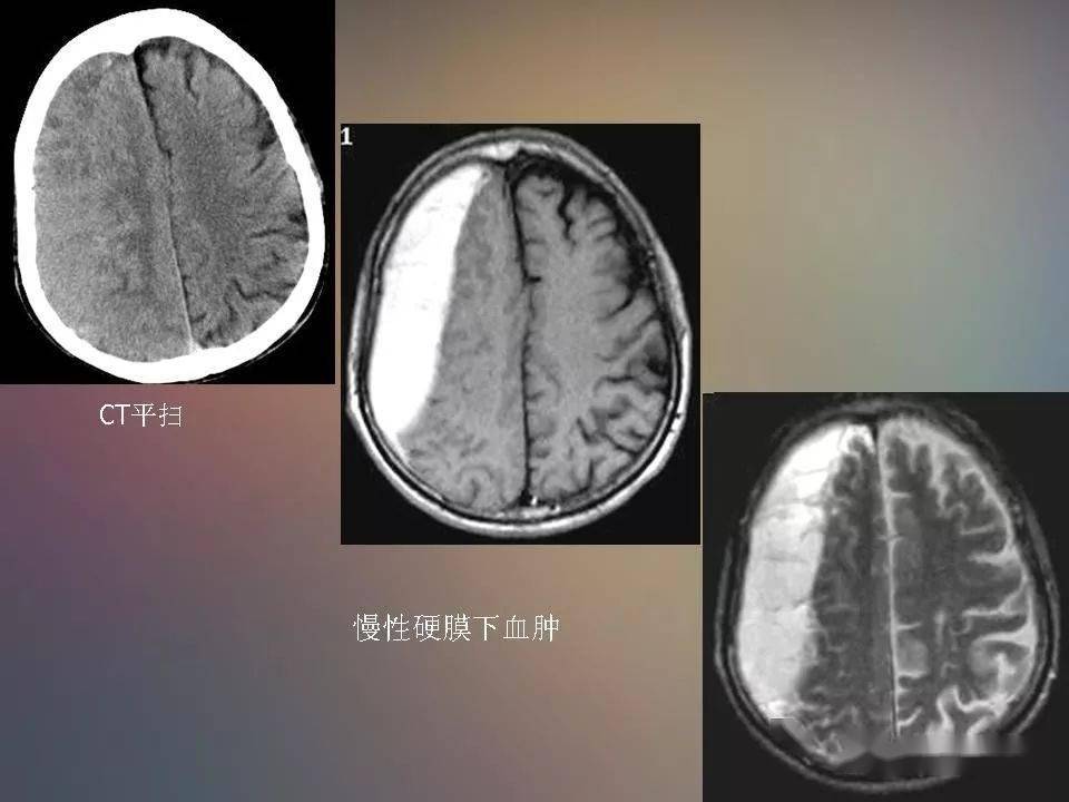 常见的急性颅脑损伤的ct和mri表现