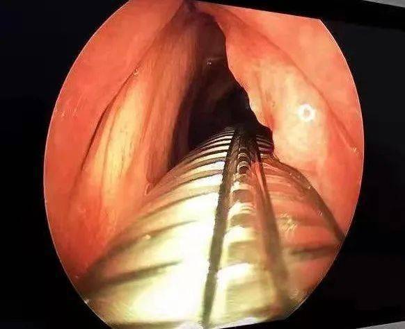 非插管全麻助力声带息肉摘除术患者走出手术室,体验舒适化医疗