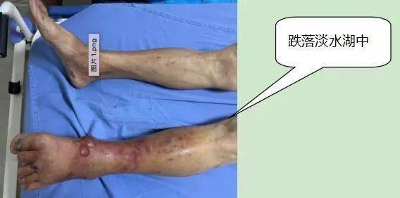 中期:感染范围更加广泛,出现水泡或大泡,疼痛和肿胀加剧,患者全身症状