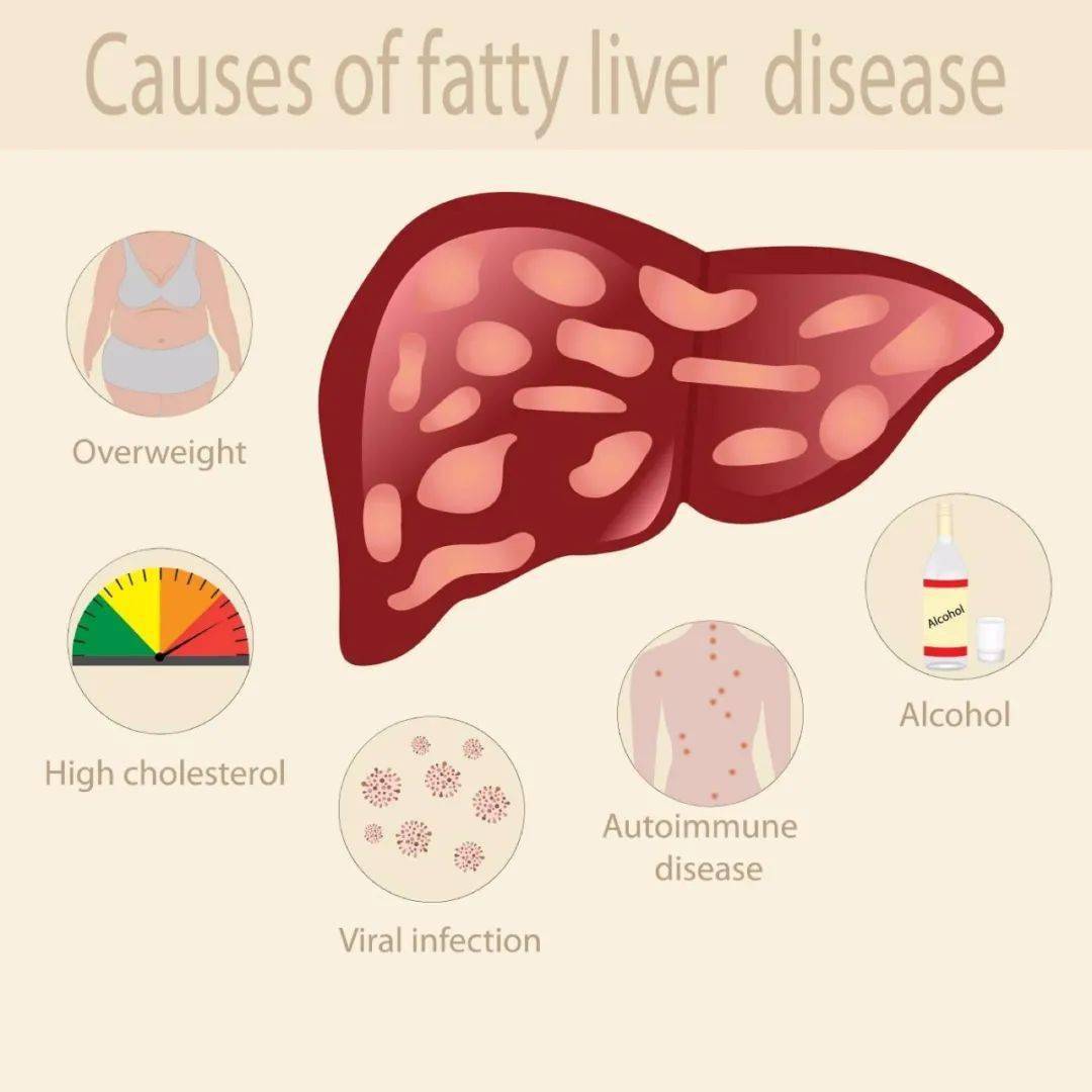 脂肪肝会变肝癌吗看懂检查报告这几项防肝癌于未然