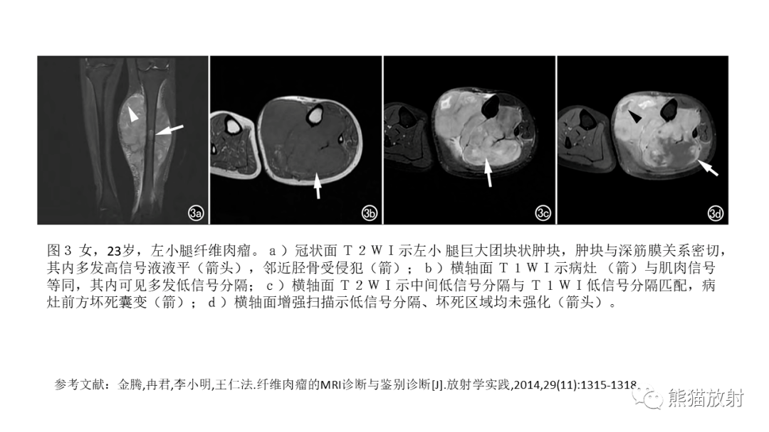 纤维肉瘤,侵袭性纤维瘤病