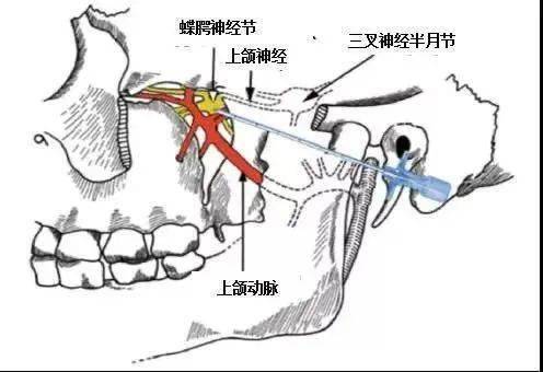 【二院耳鼻喉科】告别难受,体验鼻炎治疗第一针——蝶腭神经节针刺术