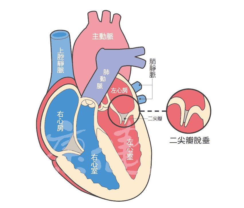 我的心脏里发出"吹风"一样的声音!_二尖瓣