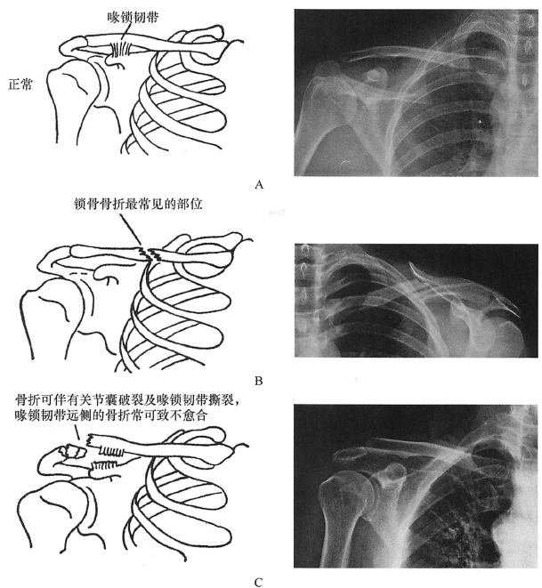 锁骨骨折