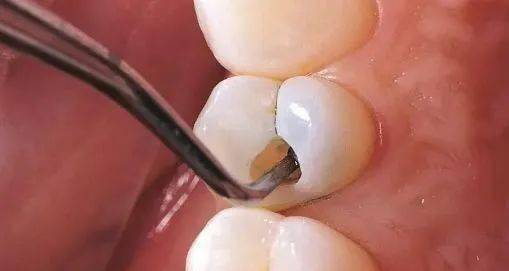 明明是去补牙,怎么医生倒把牙洞越磨越大了?
